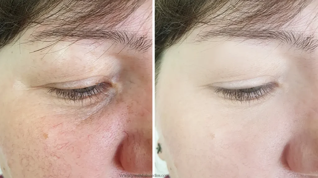 Microneedling for wrinkles before and after