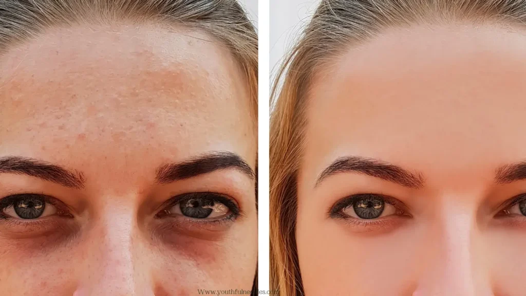Results of microneedling before and after 1 session 