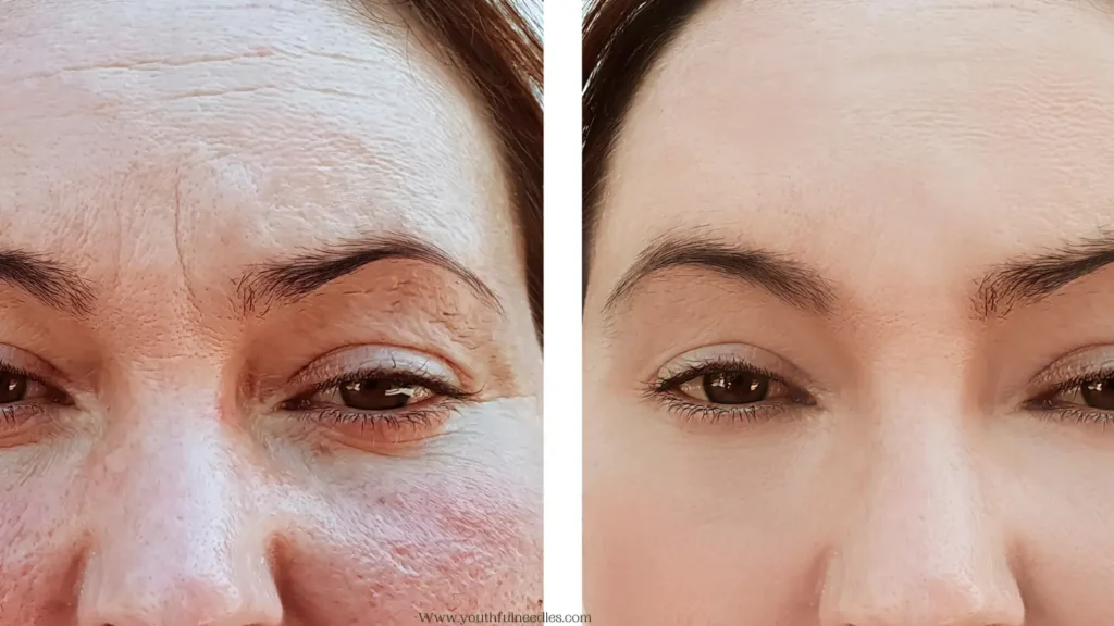 Morpheus8 under eyes before and after 1 treatment 